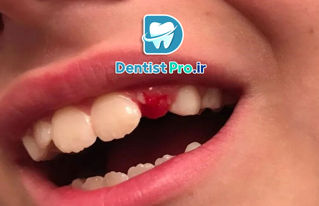 ترمیم شکستگی کوچک مینای دندان