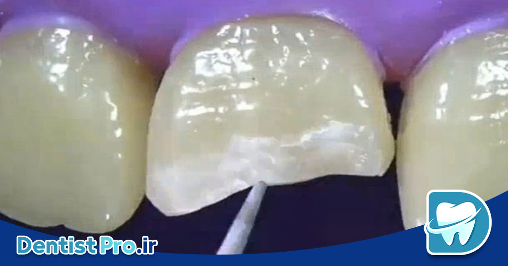 ترمیم شکستگی کوچک مینای دندان
