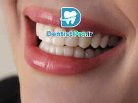 ترمیم لبخند شکسته با کامپوزیت فوری