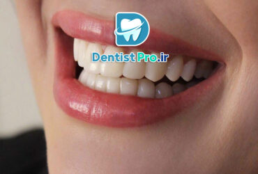 ترمیم لبخند شکسته با کامپوزیت فوری