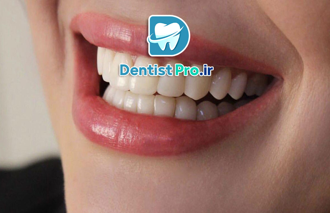 ترمیم لبخند شکسته با کامپوزیت فوری 25 ترمیم لبخند شکسته با کامپوزیت فوری