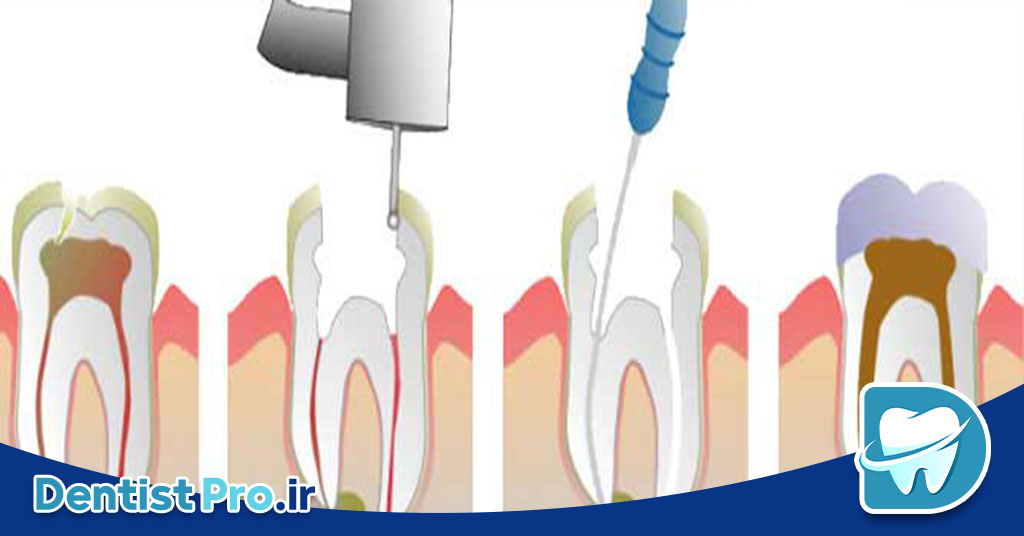 عصب کشی دندان عفونی با درد شدید