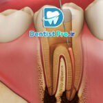 عصب کشی دندان عفونی با درد شدید