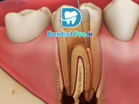 عصب کشی دندان عفونی با درد شدید