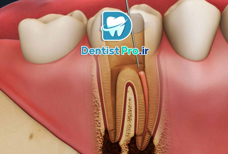 عصب کشی دندان عفونی با درد شدید