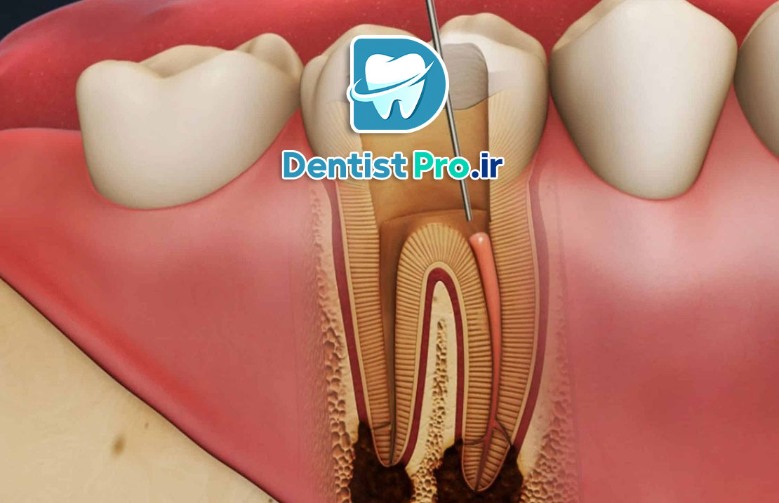 عصب کشی دندان عفونی با درد شدید