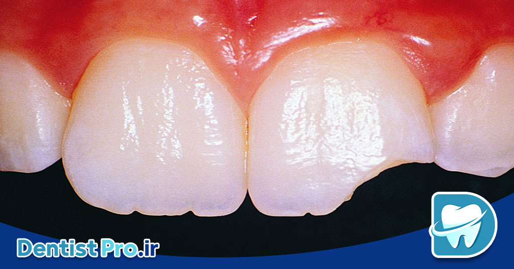 عصب کشی دندان جلویی شکسته 26 عصب کشی دندان جلویی شکسته