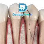 عصب کشی دندان جلویی شکسته