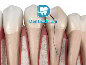 عصب کشی دندان جلویی شکسته