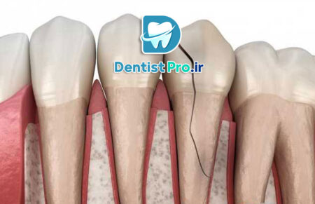 عصب کشی دندان جلویی شکسته