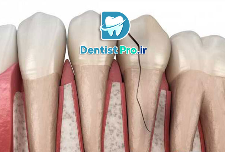 عصب کشی دندان جلویی شکسته 31 عصب کشی دندان جلویی شکسته