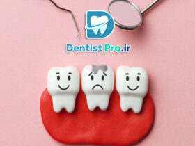 عصب کشی دندان پوسیده عمیق بدون تخریب تاج