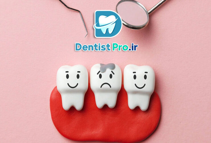 عصب کشی دندان پوسیده عمیق بدون تخریب تاج 31 عصب کشی دندان پوسیده عمیق بدون تخریب تاج