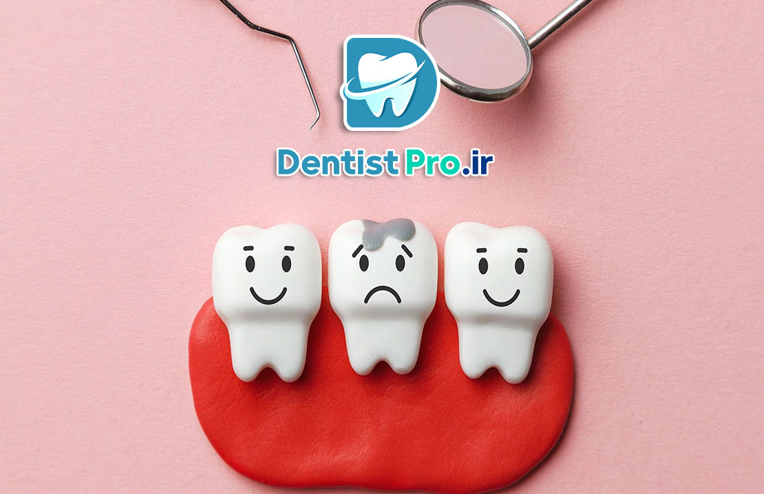 عصب کشی دندان پوسیده عمیق بدون تخریب تاج