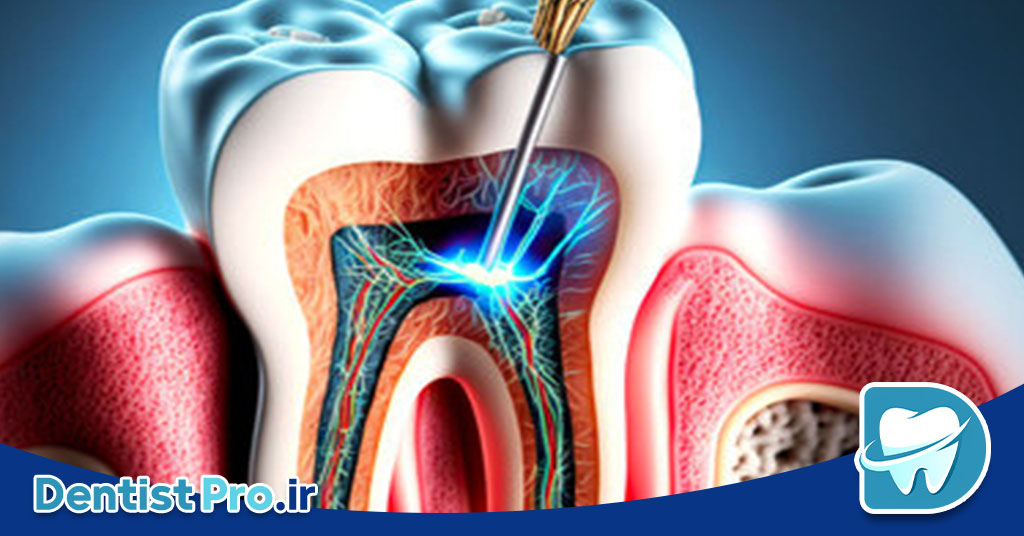 عصب کشی دندان پوسیده عمیق بدون تخریب تاج