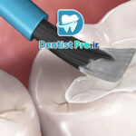 سیلنت تراپی برای پیشگیری از پوسیدگی دندان دائمی