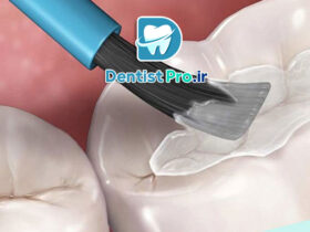 سیلنت تراپی برای پیشگیری از پوسیدگی دندان دائمی