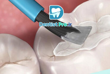 سیلنت تراپی برای پیشگیری از پوسیدگی دندان دائمی