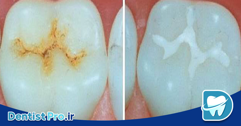 سیلنت تراپی برای پیشگیری از پوسیدگی دندان دائمی