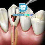 علائم نیاز به عصب کشی+10 علامت اساسی