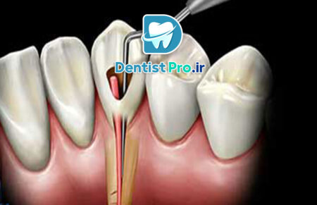 علائم نیاز به عصب کشی+10 علامت اساسی