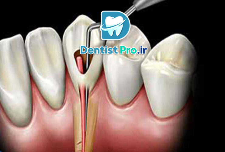 علائم نیاز به عصب کشی+10 علامت اساسی