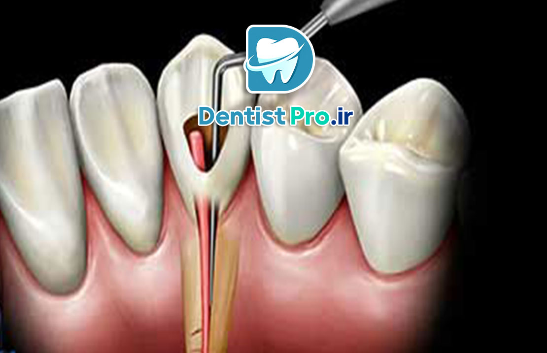 علائم نیاز به عصب کشی+10 علامت اساسی