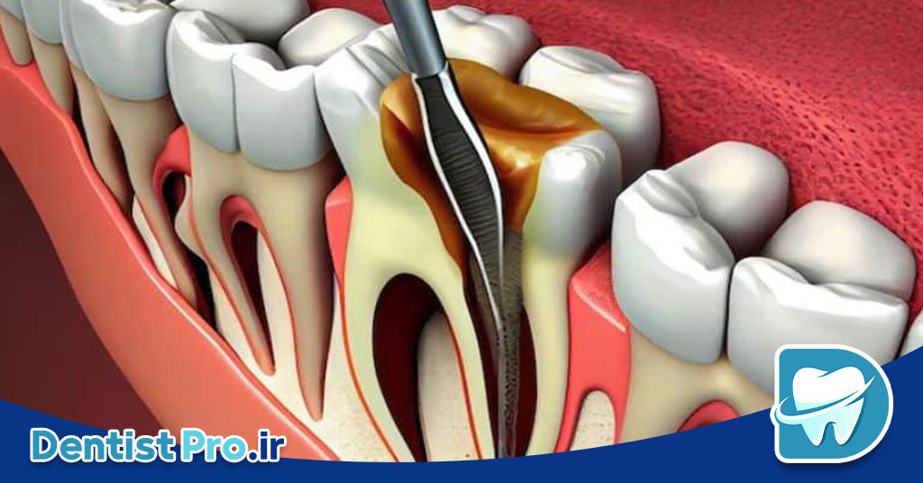 علائم نیاز به عصب کشی+10 علامت اساسی