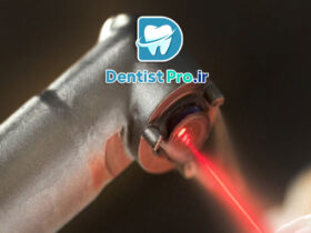 عصب کشی تخصصی دندان مولر با دستگاه روتاری