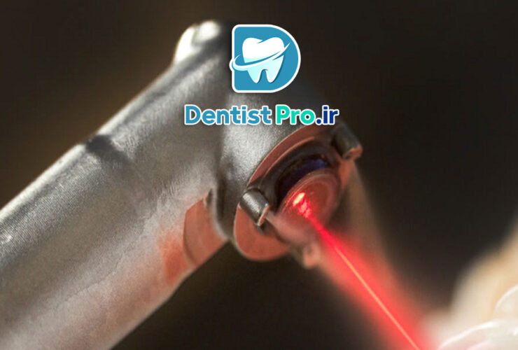 عصب کشی تخصصی دندان مولر با دستگاه روتاری