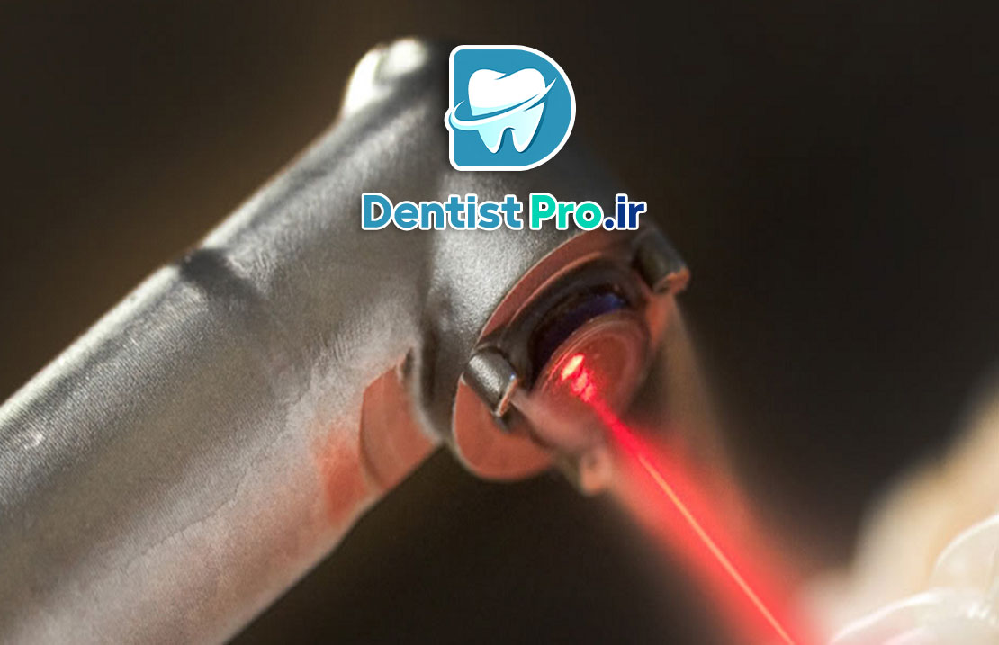 عصب کشی تخصصی دندان مولر با دستگاه روتاری