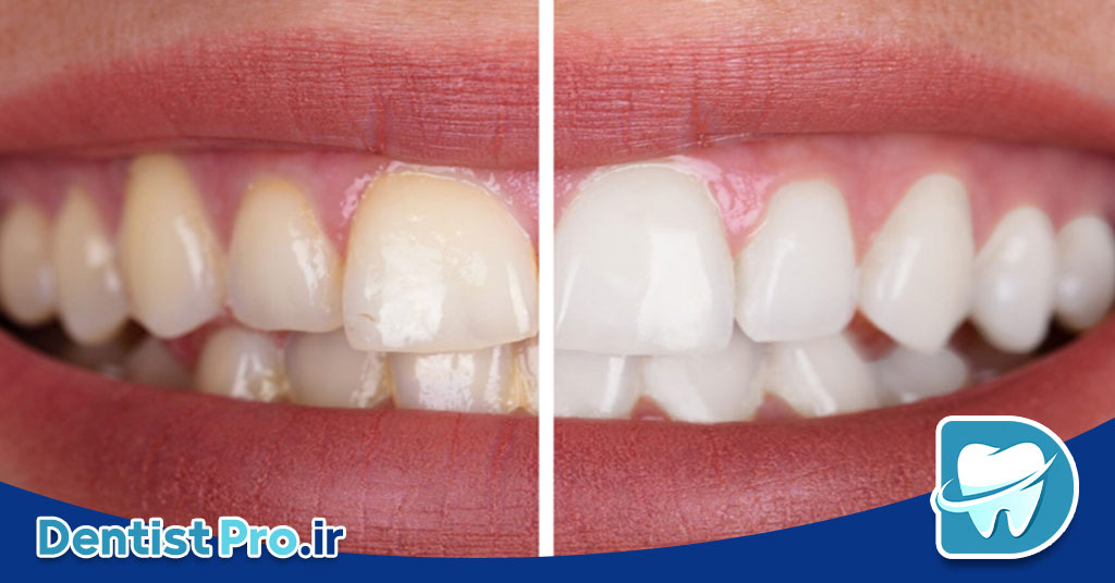 بلیچینگ قوی در مطب با نتیجه سریع