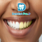 بلیچینگ قوی در مطب با نتیجه سریع