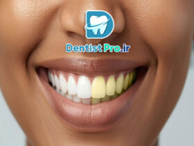 بلیچینگ قوی در مطب با نتیجه سریع