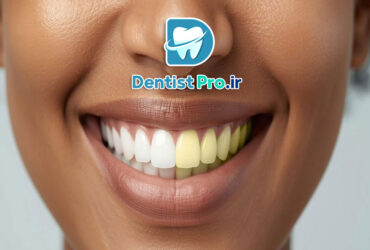 بلیچینگ قوی در مطب با نتیجه سریع