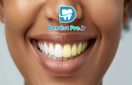 بلیچینگ قوی در مطب با نتیجه سریع