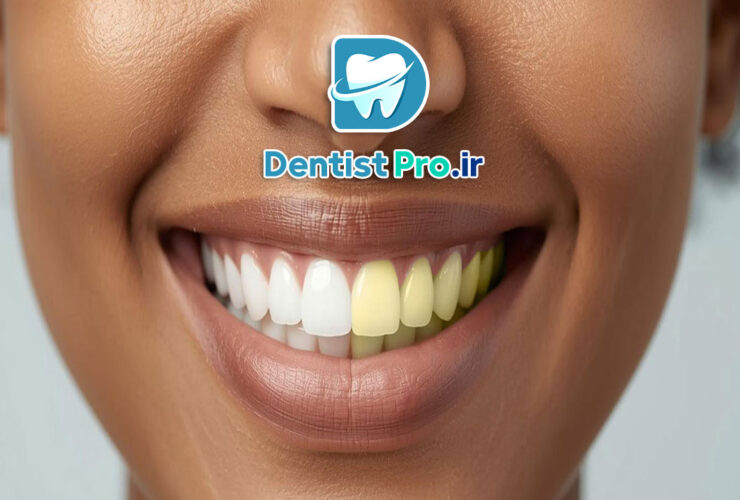 بلیچینگ قوی در مطب با نتیجه سریع 35 بلیچینگ قوی در مطب با نتیجه سریع