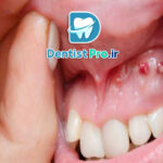 0 تا 100 درمان کیست دندان با جراحی