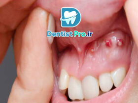 0 تا 100 درمان کیست دندان با جراحی