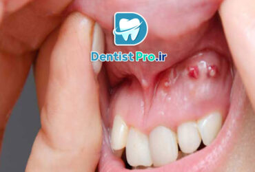 0 تا 100 درمان کیست دندان با جراحی