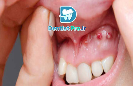 0 تا 100 درمان کیست دندان با جراحی