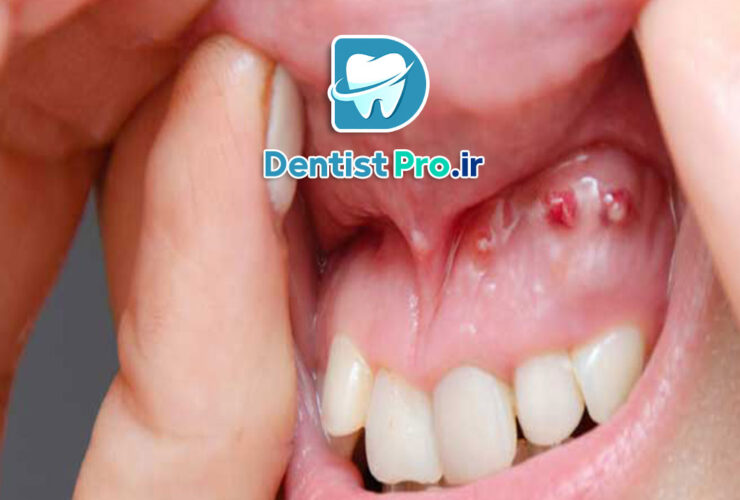 0 تا 100 درمان کیست دندان با جراحی