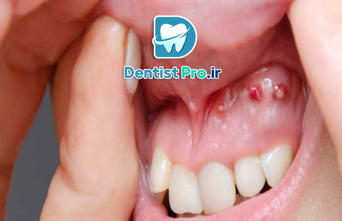 0 تا 100 درمان کیست دندان با جراحی 25 0 تا 100 درمان کیست دندان با جراحی