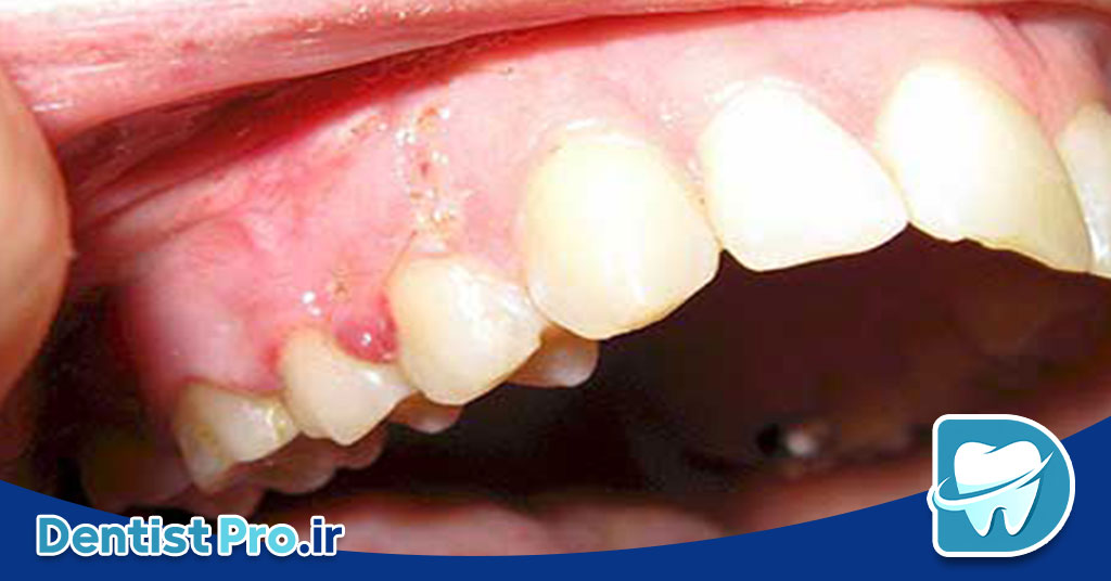 0 تا 100 درمان کیست دندان با جراحی 26 0 تا 100 درمان کیست دندان با جراحی