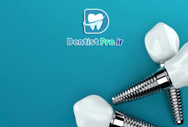 بررسی 0 تا 100 ایمپلنت سوئیسی با گارانتی