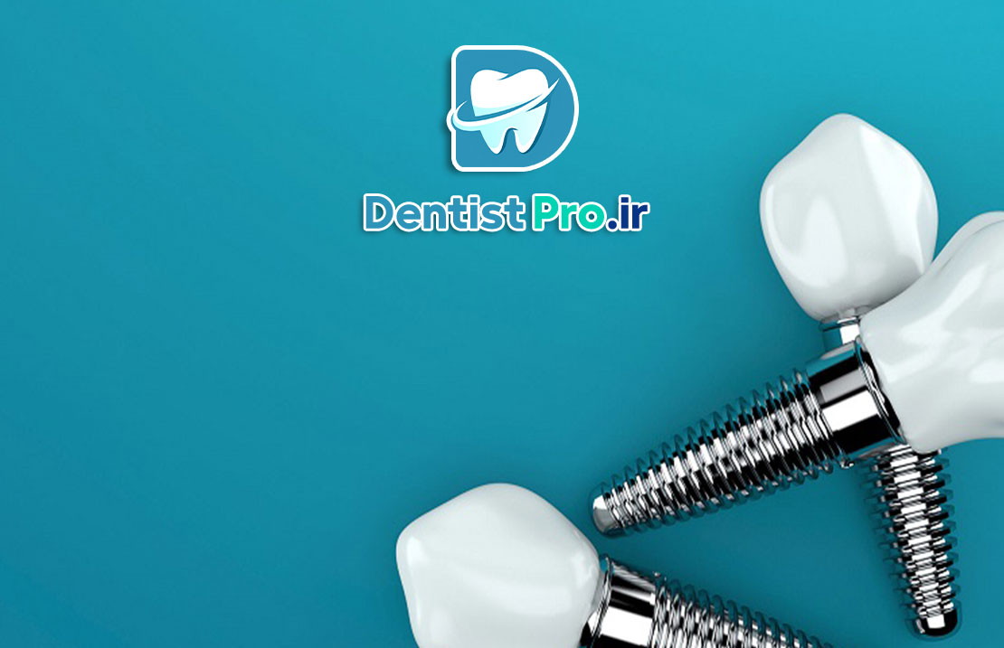 بررسی 0 تا 100 ایمپلنت سوئیسی با گارانتی