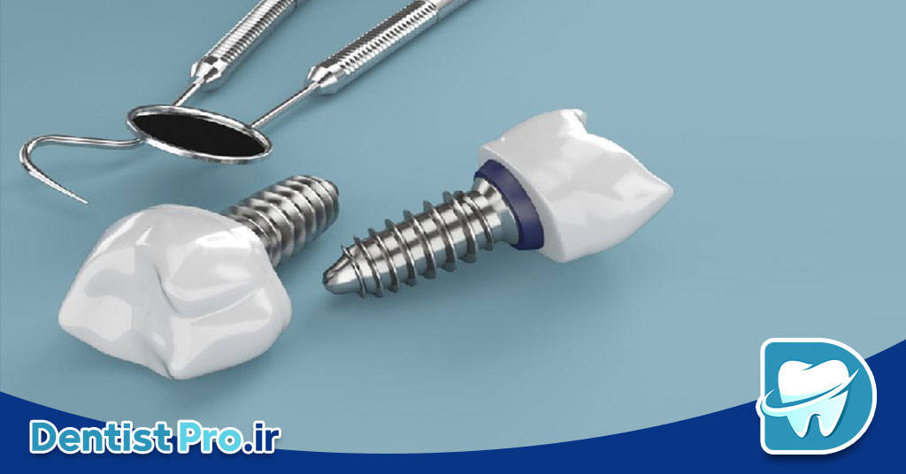 بررسی 0 تا 100 ایمپلنت سوئیسی با گارانتی