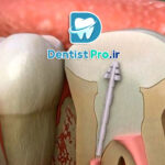 آیا عصب کشی دندان در یک جلسه امکان پذیر است؟