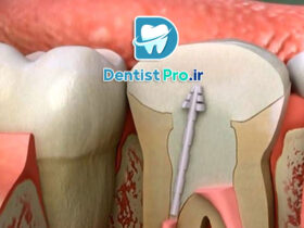 آیا عصب کشی دندان در یک جلسه امکان پذیر است؟