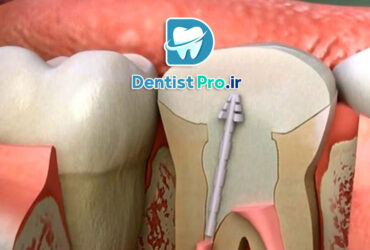 آیا عصب کشی دندان در یک جلسه امکان پذیر است؟